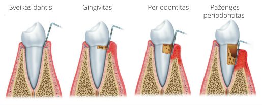 periodontitas